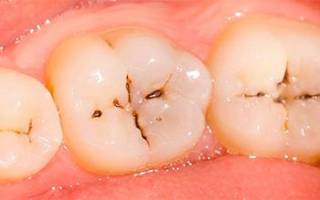Как определить кариес на зубах
