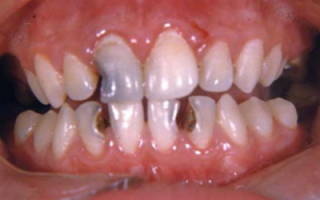 Почему гниют зубы изнутри