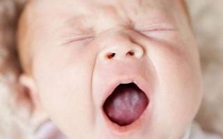 Молочница у новорожденных во рту симптомы
