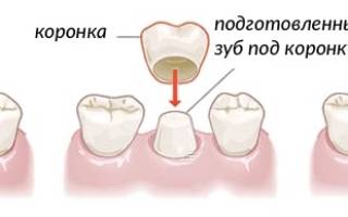Установка коронок на зубы