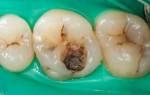 Болезнь зубов пульпит