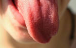 Причины жжения во рту и языка