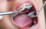 Можно ли лечить зубы с брекетами