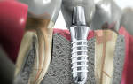 Из чего состоит имплант зуба
