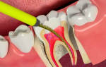 Удаление нерва в молочном зубе