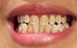 Что делать если желтые зубы