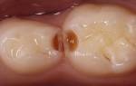Могут ли болеть молочные зубы у детей
