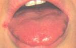 Жжение губ и языка причины