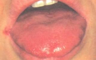 Жжение губ и языка причины