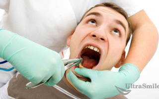 Удаление зубов на верхней челюсти
