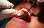 Удаление нерва зуба мышьяком