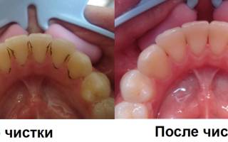 Профессиональная чистка зубов до и после