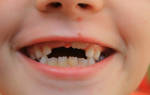 Прорезывание коренных зубов у детей