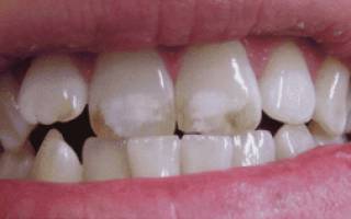 Пятна на зубах у ребенка
