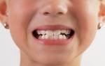 Сроки прорезывания зубов у детей таблица