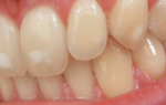Меловидные пятна на зубах