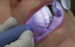 Как проходит ультразвуковая чистка зубов