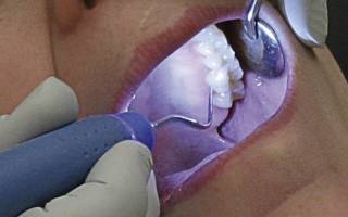 Как проходит ультразвуковая чистка зубов