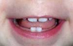 Сколько всего молочных зубов