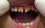 Почему гниют зубы изнутри