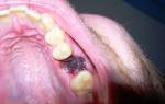 Удалили коренной зуб сколько будет болеть