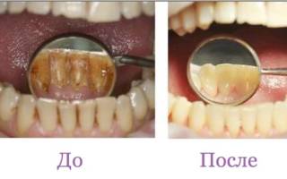 Гигиеническая чистка зубов что это такое