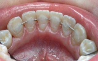 Что такое ретейнеры для зубов