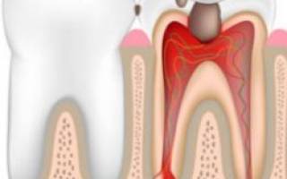 Воспаление нерва зуба