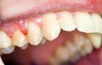 Воспаление зуба под коронкой что делать