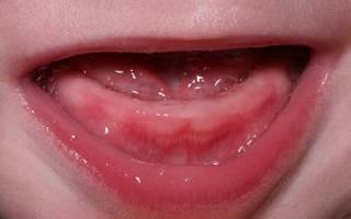 Чем обезболить десна при прорезывании зубов