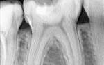 Как делают рентген зубов