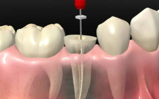Что такое депульпация зуба
