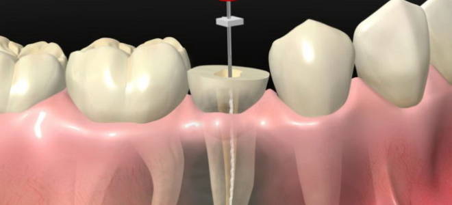 Пульпировать зуб это