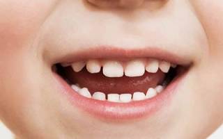 Детский кариес молочных зубов
